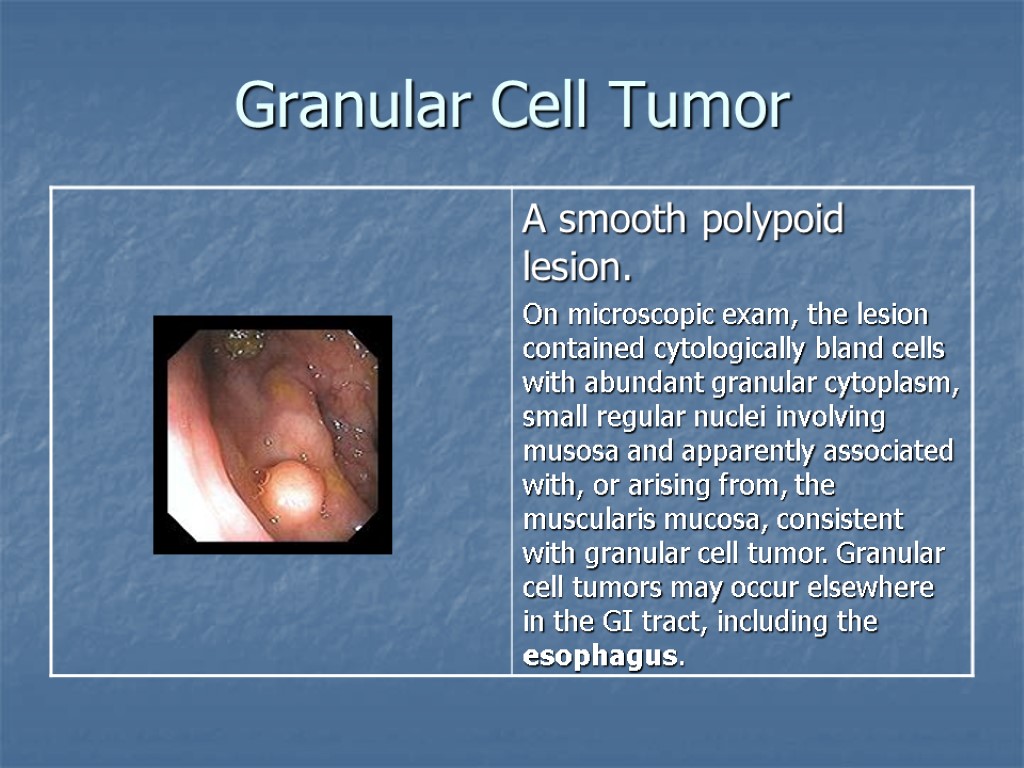 Granular Cell Tumor